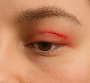 What is an Eyelid Laceration