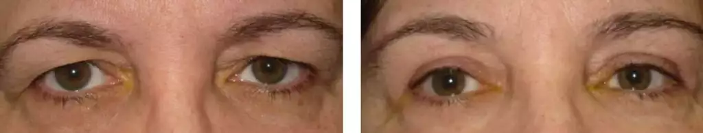 Blepharoplasty upper eyelid before after