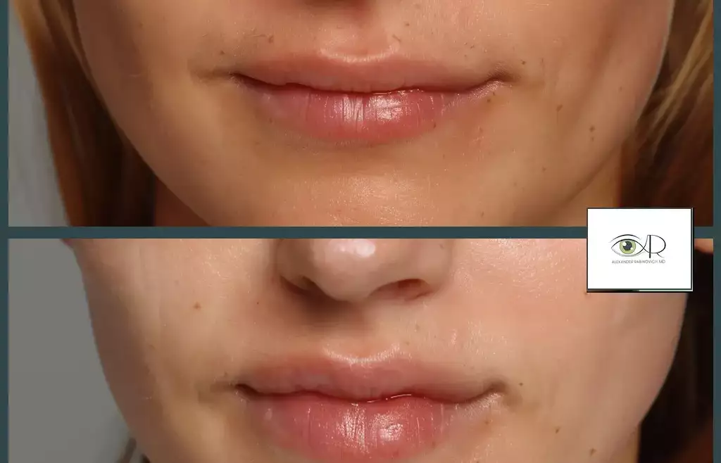 Enhance Your Lips Beauty Safely