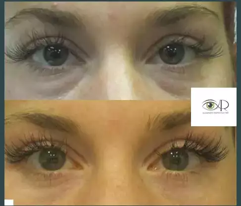 What 6 problems can be eliminated with Lower eyelid blepharoplasty?