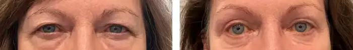 4_eyelid2