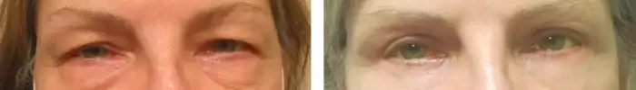 4_lid