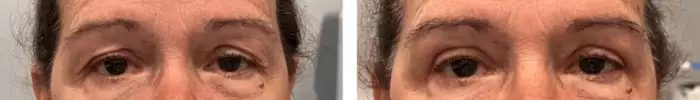 Upper lid blepharoplasty_before_ufter_2