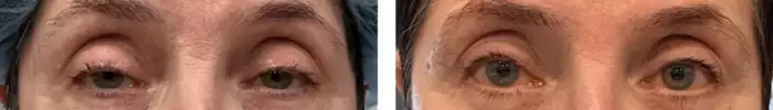ptosis_repair_lower_eyelid_before_after_1