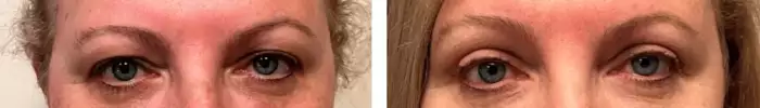 ptosis_repair_lower_eyelid_before_after_3