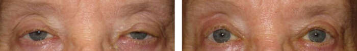 Droopy_eyelid_13