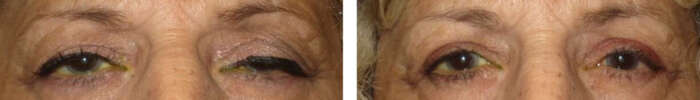 Droopy_eyelid_14