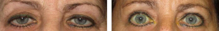 Droopy_eyelid_2