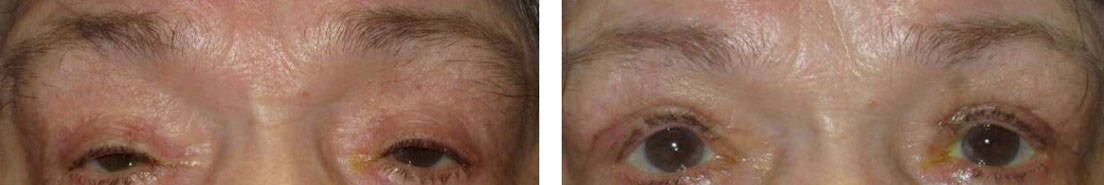 Droopy eyelid bfore and after
