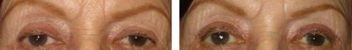 Droopy_eyelid_6