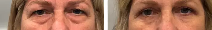 4_eyelid_blepharoplasty_before_after