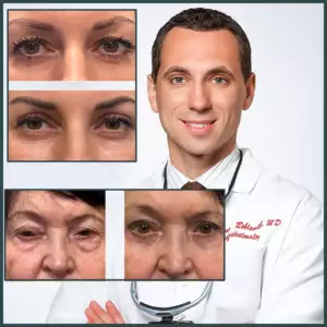 blepharoplasty