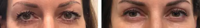Upper_Eyelid_blepharoplasty_before_after2