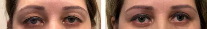 lower_eye_blepharoplasty_before_after