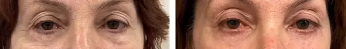 lower_eye_blepharoplasty_before_after2